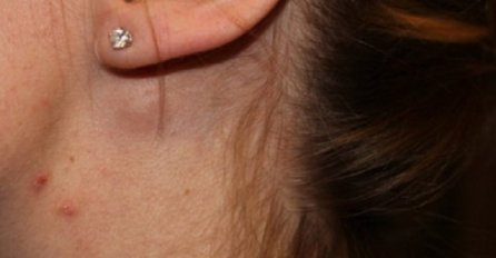 LIMFNI ČVOROVI OTIČU KAD IMATE OVU BOLEST: Upozorenje svima, EVO ŠTA VAM SE DOGAĐA U ORGANIZMU