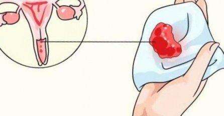 "Oboljela sam od raka maternice samo godinu dana nakon što sam se udala."