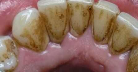 SVAKO JUTRO ISPERITE USTA SA OVIM: Kad se sutra nasmijete, niko neće vjerovati da niste radili IZBJELJIVANJE kod profesionalca!