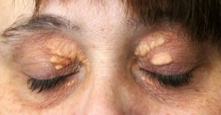 IMATE MASNO TKIVO IZNAD OKA? Ni slučajno ne dirajte, OBAVEZNO URADITE OVO!