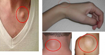 POJAVILE SU VAM SE OVAKVE IZRASLINE? Imate razlog za brigu, OPASNE SU! Ovako ih se možete riješiti PREKO NOĆI I IZBJEĆI OPERACIJU!