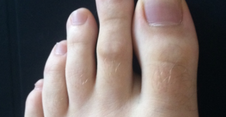 IMATE LI OVAKAV NOŽNI PRST? Mnogima je ovo odvratno, A EVO KAKVU TAJNU KRIJE!