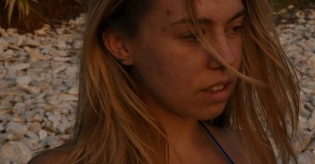 ZBOG BOLNIH AKNI NE MOŽE DA SPAVA, A PRIJATELJI JE IZBJEGAVAJU JER IM SE GADI:  Sad je javno POKAZALA LICE, svi se ZGRAŽAVAJU!