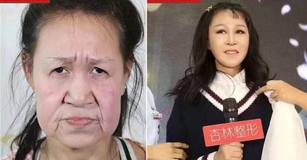 IMA 15 GODINA I LICE STARICE, DJEVOJČICA BOLUJE OD RIJETKOG POREMEĆAJA: Godinama su je ismijavali, a sad je  otišla na OPERACIJU, TRASFORMACIJA JE NEVJEROVATNA