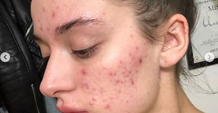 ZBOG POLICISTIČNIH JAJNIKA SE DEBLJATE, IMATE BUBULJICE I DLAKE PO LICU: Svaka žena ovo treba znati!