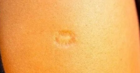 AKO STE ROĐENI U JUGOSLAVIJI, ONDA SIGURNO IMATE OVAJ OŽILJAK NA RUCI: Znate li od čega?