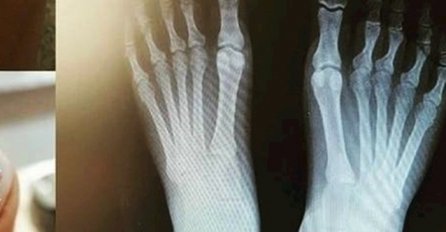 AUH, OVO JE GADNO, ŽENA OTIŠLA KOD DOKTORA DA SNIMI RENDGEN STOPALA: Kad je doktor ugledao ovo na PALCU umalo se srušio! (FOTO)
