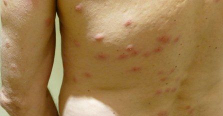 DESET UJEDA RAZLIČITIH VRSTA KUKACA: Evo kako da znate KOJI VAS JE UJEO  - OVO VAM MOŽE SPASITI ŽIVOT