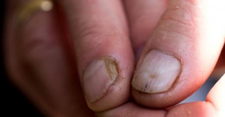 EVO KAKO DA OČISTITE NOKTE OD GLIVICA: Poslije ovog bolest se ne širi i ne vraća!