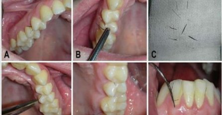 DOKTORI ZANIJEMILI, pacijentkinji počele da rastu DLAKE U USTIMA: Razlog je ZABRINJAVAJUĆI