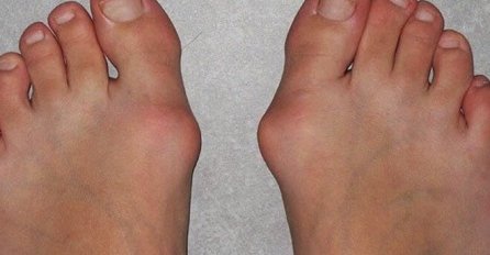 ČUKLJEVI NESTAJU  KAO RUKOM ODNEŠENI: Riješite ih se na prirodan NAČIN, BEZ OPERACIJE!