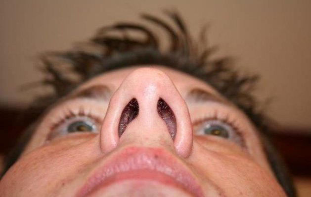 bakterije-u-nosu-600x381