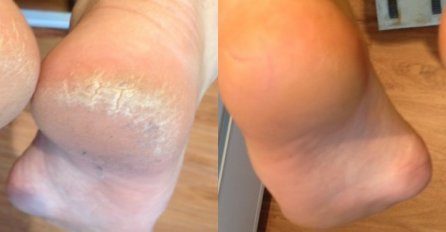 RIJEŠITE SE GRUBIH I ISPUCALIH PETA: Sve što vam treba je JEDNA NAMIRNICA, BIĆETE ODUŠEVLJENE