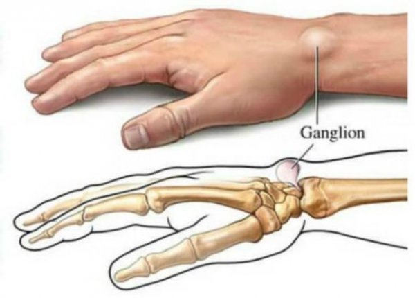 ganglion-2
