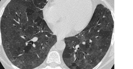 ZARAŽEN KORONA VIRUSOM, ALI NEMA SIMPTOME: Evo šta se dešava njegovim plućima