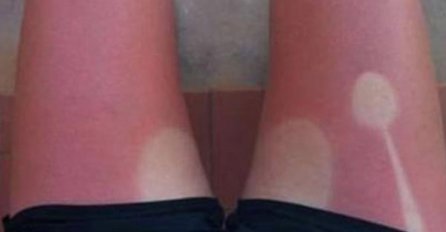 BOLJE DA NISU IZ KUĆE IZLAZILI, OVO SU NAJSMJEŠNIJE OPEKOTINE OD SUNCA: Kad vidite momka broj 3. SUZE ĆE VAM KRENUTI