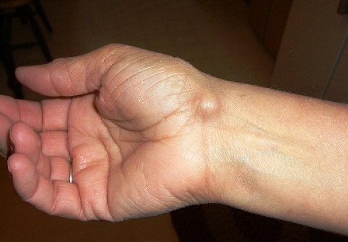 liječenje posttraumatske artroze prsta upaljeno desno koljeno