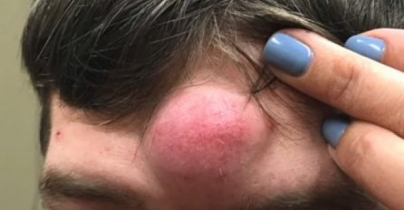 NA ČELU MU JE RASLA DŽINOVSKA BUBULJICA, ZVALI SU GA JEDNOROG: Otišao je u bolnicu, A KAD SU VIDJELI ŠTA JE IZAŠLO IZ NJE, DOŠLO IM ZLO (VIDEO)