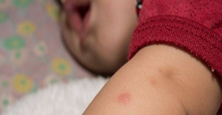 DR. NESTOROVIĆ OTKRIO SPAS OD KOMARACA: Morate prestat jest OVO!