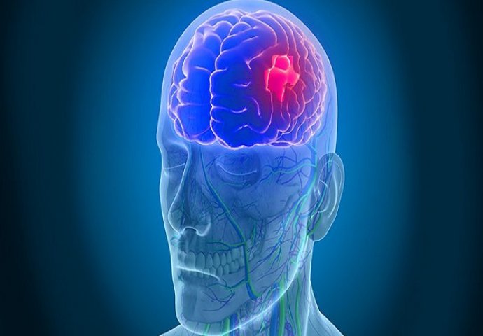 BRINITE O VAŠEM ZDRAVLJU: Kako prepoznati moždani udar URADITE BRZI TEST