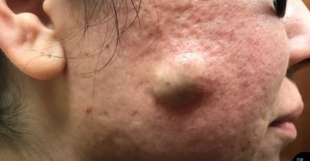 OGROMNA IZRASLINA MU JE GODINAMA BILA NA OBRAZU: Otišao je u bolnicu da mu to iscijede, KAD VIDITE ŠTA JE IZAŠLO BIĆE VAM ZLO (VIDEO)