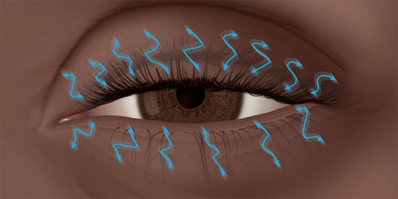 eyelid-spasms