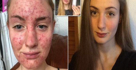 DVIJE GODINE TRPI POSLJEDICE OVIH TABLETA: 'Nisam gledala ljude u oči, LICE MI JE KRVARILO bilo puno bubuljica i cista'