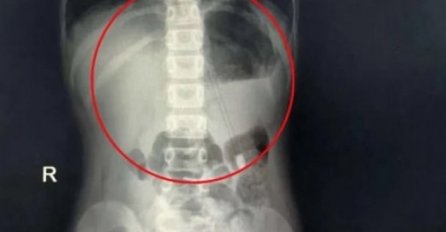 RODITELJI PLAČUĆI DOVELI SINA U BOLNICU,  DOKTORI ODMAH URADILI RENDGEN PA DOŽIVJELI VELIKI ŠOK: Pogledajte šta je dijete PROGUTALO, STRAŠNO!