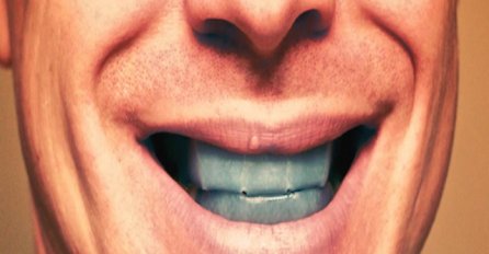 ZBOG NAJNOVIJEG TRENDA MOŽETE OSTATI BEZ ZUBA: Nova metoda izbjeljivanja može dovesti do ozbiljnih opekotina u unutrašnjem dijelu usta