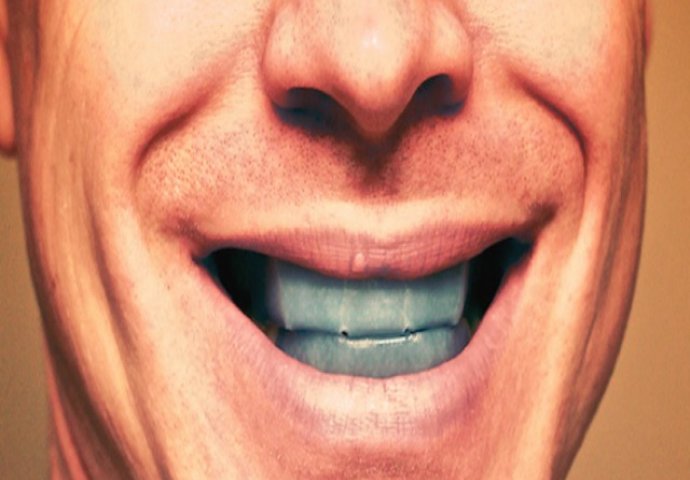 ZBOG NAJNOVIJEG TRENDA MOŽETE OSTATI BEZ ZUBA: Nova metoda izbjeljivanja može dovesti do ozbiljnih opekotina u unutrašnjem dijelu usta