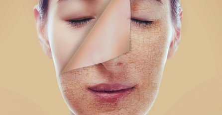 IMATE PROBLEM SA SUHOM I ISPUCALOM KOŽOM? Kućna krema od SAMO 3 SASTOJKA je rješenje vaših muka 