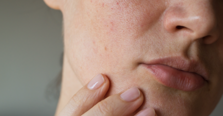 MNOGI ZANEMARE SVRAB, ALI MOŽE BITI SIMPTOM OPASNE BOLESTI: Ovo je 10 razloga zbog čega koža može da svrbi