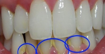 OVAJ TRIK ĆE VAM SAČUVATI I VRIJEME I NOVAC: Uklonite dentalni plak ZA SAMO 5 MINUTA, BEZ ODLASKA ZUBARU!