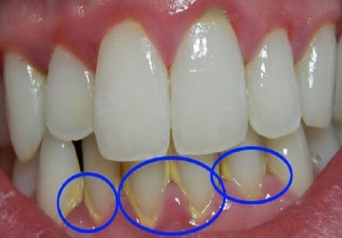 OVAJ TRIK ĆE VAM SAČUVATI I VRIJEME I NOVAC: Uklonite dentalni plak ZA SAMO 5 MINUTA, BEZ ODLASKA ZUBARU!