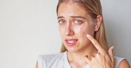 LICE JOJ JE BILO PREPUNO AKNI I OŽILJAKA: Onda je počela mazati OVU SMJESU koju je sama napravila, SVI OSTALI BEZ RIJEČI (RECEPT)