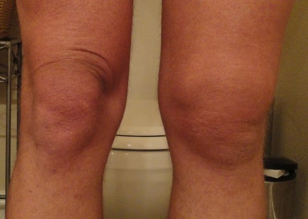 swollen-knee2