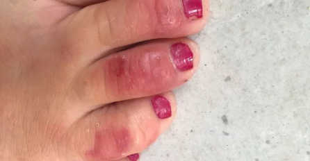 OPREZNO AKO PRIMJETITE OVO NA DJECI ODMAH REAGUJTE:  Na ovih 8 vrsta osipa morate obratiti pažnju NAROČITO SE JAVLJAJU KOD DJECE 