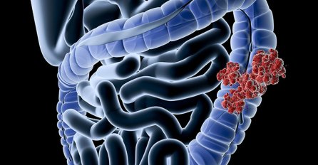 Ovo su 4 znaka raka debelog crijeva koje tijelo šalje mjesecima prije dijagnoze