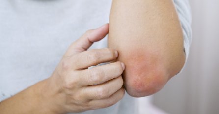 DOKTORI UPOZORAVAJU: Suhi laktovi nisu bezazlena pojava, već prvi znak neizlječive bolesti!