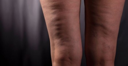 Najjači neprijatelj CELULITA: Pomiješajte OVA DVA sastojka koja sigurno VEĆ IMATE u kući!