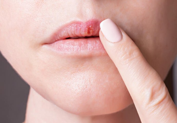 Evo kako da se oslobodite herpesa na usnama preko noći: OVO PROVJERENO UBLAŽAVA UPALU