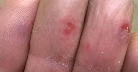 UZNEMIRUJUĆE FOTOGRAFIJE ZARAŽENIH KORONOM Ovo se sve češće javljaju kod oboljelih