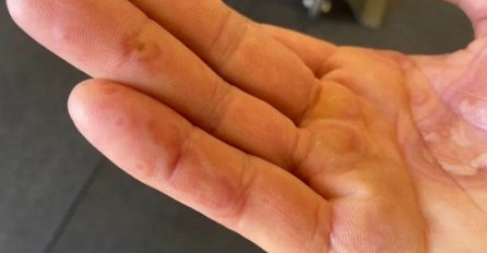 TRNU LI VAM PRSTI? NE IGRAJTE SE, TO JE SIMPTOM: Evo šta može biti u pitanju!