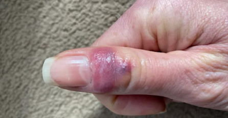 OBOLJELI OD KORONE POSLALI SLIKE: Evo kako stvarno izgledaju KOVID PRSTI NA RUKAMA I NOGAMA