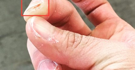 LISTAJU VAM SE NOKTI? Ovo bi mogli biti razlozi OBRATITE PAŽNJU