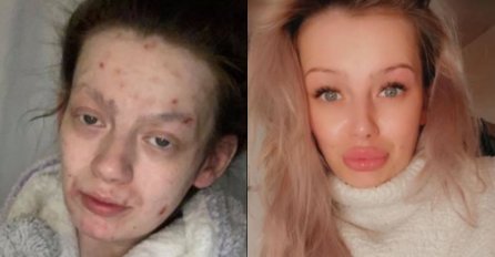 ŠOKANTNA TRANSFORMACIJA: Drogirala se 2 godine, poslije 4 mjeseca bez droge izgleda kao druga osoba!