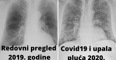 HRVAT PRIJE DVA DANA PRIMLJEN U BOLNICU: Ovo lijevo su njegova pluća 2019. godine, a DESNO JE COVID19 I UPALA PLUĆA 2020. (FOTO)