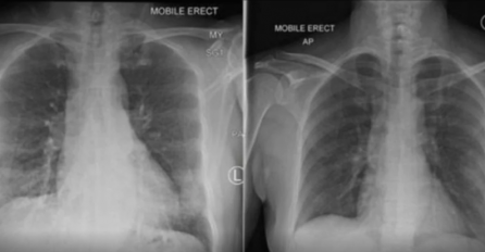 Paracetamol, oksimetar, vitamini... Evo šta sve trebate imati u kućnoj apoteci za slučaj da se zarazite koronom