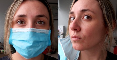 ČEST PROBLEM ZBOG NOŠENJA MASKE: Jednostavni TRIK štiti kožu od AKNI