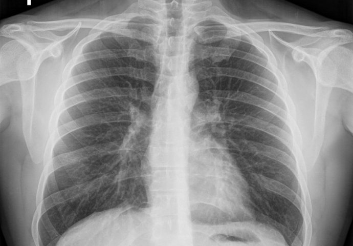 Dr Slavica spasila život oboljelom od korone i to preko Tvitera: Poslao je ovaj snimak pluća
